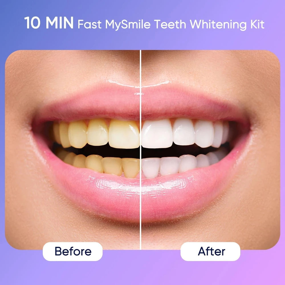 MySmile Deluxe Teeth Whitening Kit